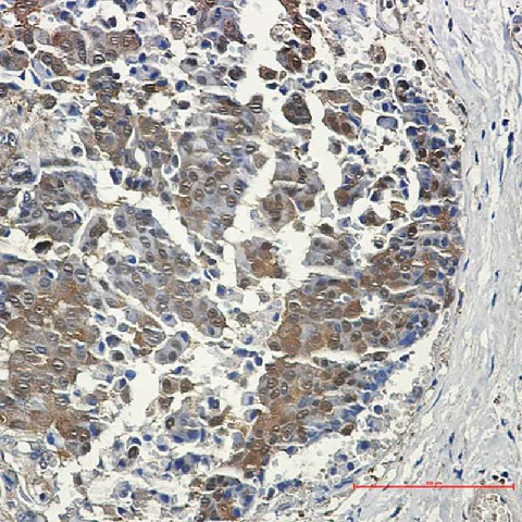 Immunohistochemistry of eIF4EBP1 in paraffin-embedded Human breast cancer tissue using eIF4EBP1 Rabbit mAb at dilution 1:50