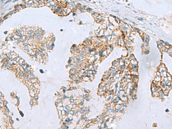 Immunohistochemistry of paraffin-embedded Human gastric cancer tissue  using MGME1 Polyclonal Antibody at dilution of 1:70(?200)