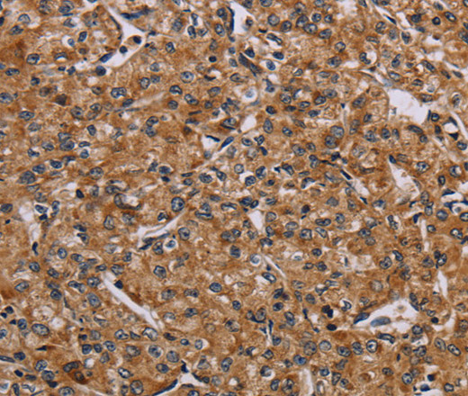 Immunohistochemistry of paraffin-embedded Human prostate cancer tissue using AATK Polyclonal Antibody at dilution 1:45