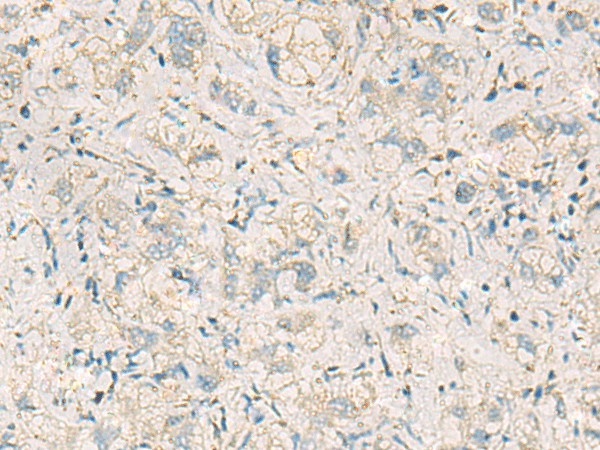 Immunohistochemistry of paraffin-embedded Human liver cancer tissue  using WDR37 Polyclonal Antibody at dilution of 1:50(?200)