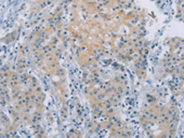 Immunohistochemistry of paraffin-embedded Human gastric cancer tissue  using ZAK  Polyclonal Antibody at dilution of 1:100(?200)