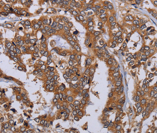 Immunohistochemistry of paraffin-embedded Human liver cancer tissue using MFAP3L Polyclonal Antibody at dilution 1:50