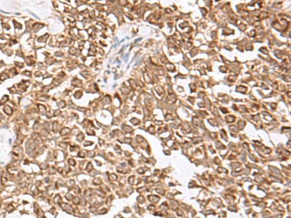 Immunohistochemistry of paraffin-embedded Human ovarian cancer tissue  using USP16 Polyclonal Antibody at dilution of 1:25(?200)