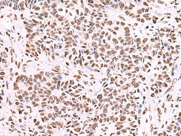 Immunohistochemistry of paraffin-embedded Human ovarian cancer tissue  using NASP Polyclonal Antibody at dilution of 1:55(?200)