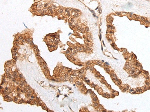 Immunohistochemistry of paraffin-embedded Human thyroid cancer tissue  using HOXB9 Polyclonal Antibody at dilution of 1:45(?200)