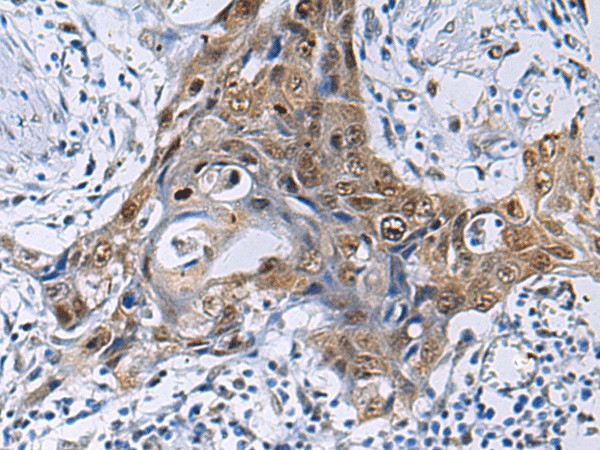 Immunohistochemistry of paraffin-embedded Human esophagus cancer tissue  using THOC3 Polyclonal Antibody at dilution of 1:50(?200)