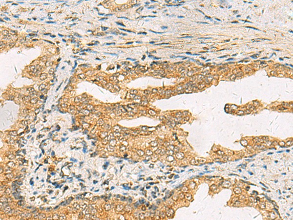 Immunohistochemistry of paraffin-embedded Human prost ate cancer tissue  using STX6 Polyclonal Antibody at dilution of 1:45(?200)