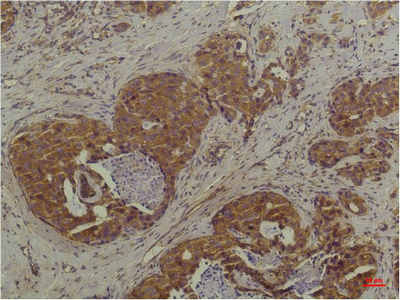 Immunohistochemistry of paraffin-embedded Human breast carcinoma tissue using ERK 1/2 Monoclonal Antibody at dilution of 1:200.