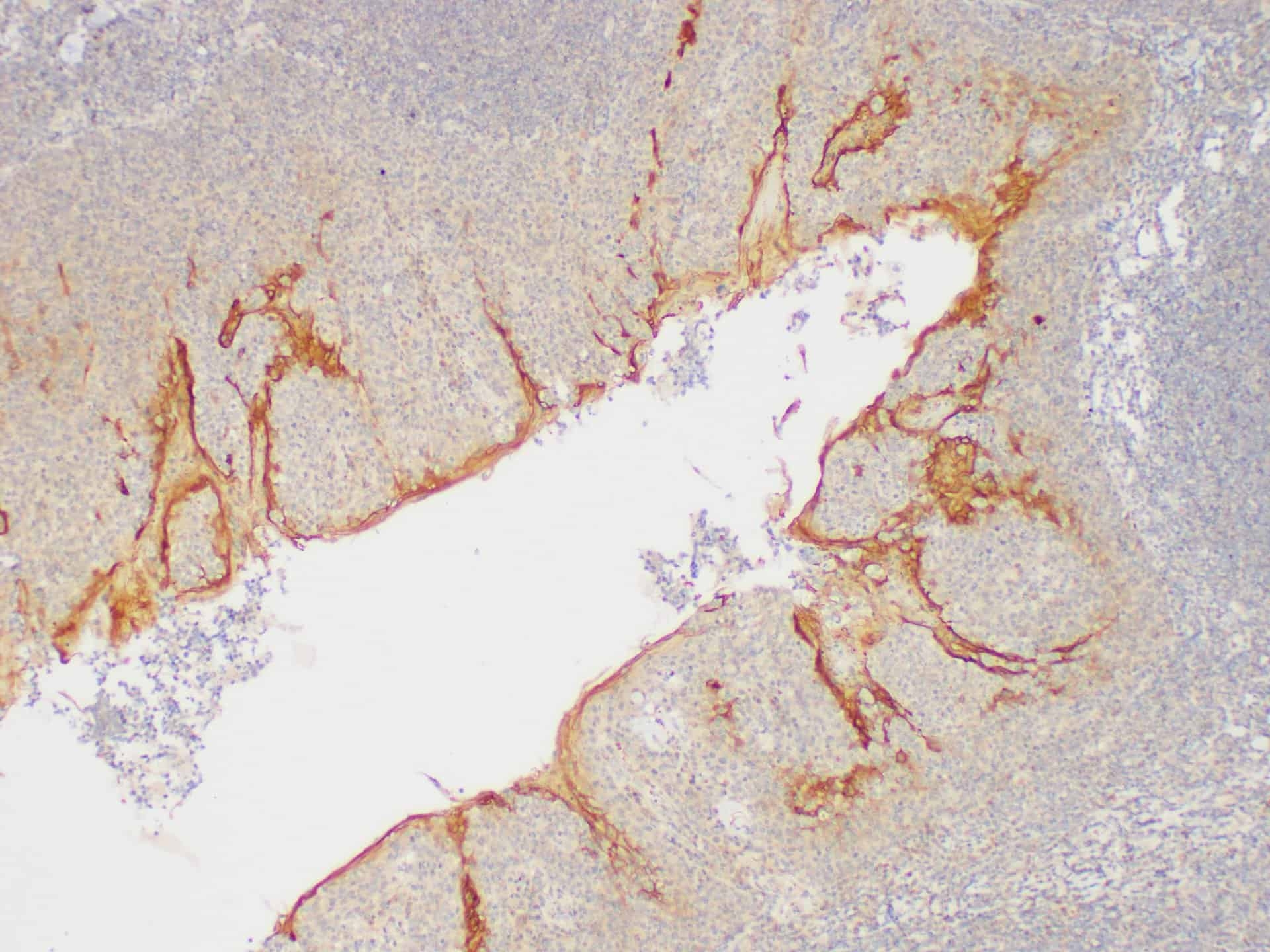 Immunohistochemistry of paraffin-embedded Human tonsil using SERPINB2 Polycloanl Antibody at dilution of 1:200