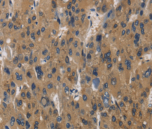 Immunohistochemistry of paraffin-embedded Human liver cancer using RAGE Polyclonal Antibody at dilution of 1:70