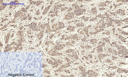 Immunohistochemistry of paraffin-embedded Human liver cancer tissue using alpha Tubulin Polyclonal Antibody at dilution of 1:200.