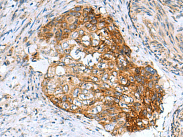 Immunohistochemistry of paraffin-embedded Human cervical cancer tissue  using AP1S3 Polyclonal Antibody at dilution of 1:55(?200)