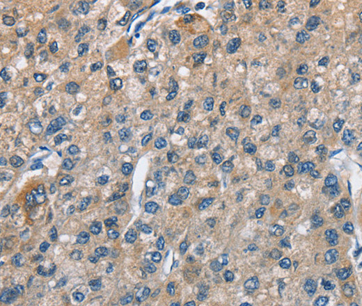 Immunohistochemistry of paraffin-embedded Human liver cancer using TRIP4 Polyclonal Antibody at dilution of 1:50