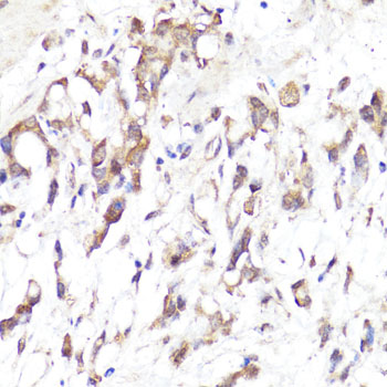 Immunohistochemistry of paraffin-embedded human gastric cancer using CD62L/L-Selectin Polyclonal antibody at dilution of 1:100 (40x lens).Perform microwave antigen retrieval with 10 mM PBS buffer pH 7.2 before commencing with IHC staining protocol.