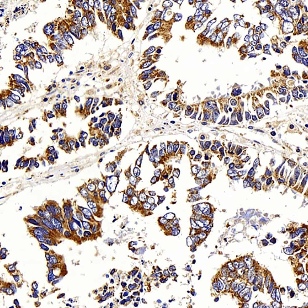 Immunohistochemistry analysis of paraffin-embedded human stomach  cancer  using ATG5 Polyclonal Antibody at dilution of 1:400.