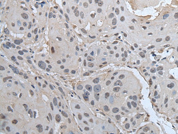 Immunohistochemistry of paraffin-embedded Human esophagus cancer tissue  using SMC1A Polyclonal Antibody at dilution of 1:45(?200)