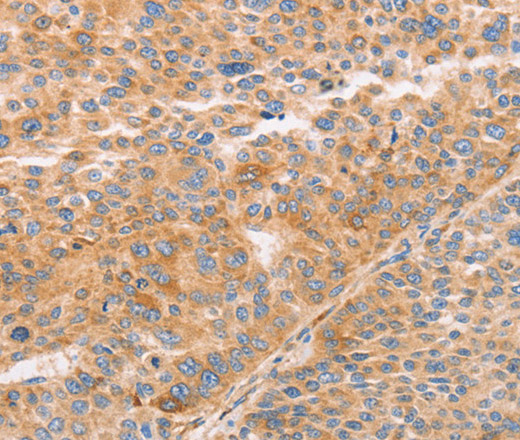 Immunohistochemistry of paraffin-embedded Human liver cancer using STK4 Polyclonal Antibody at dilution of 1:70