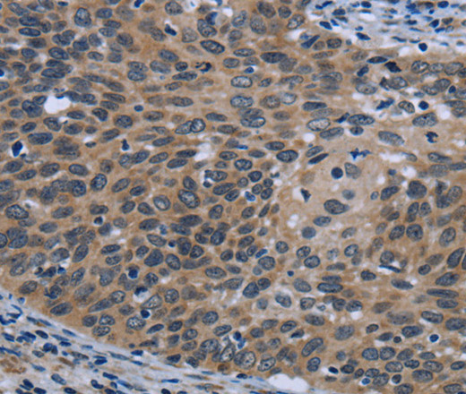 Immunohistochemistry of paraffin-embedded Human cervical cancer using AVEN Polyclonal Antibody at dilution of 1:30