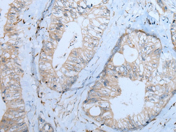 Immunohistochemistry of paraffin-embedded Human colorectal cancer tissue  using CNTN1 Polyclonal Antibody at dilution of 1:55(?200)