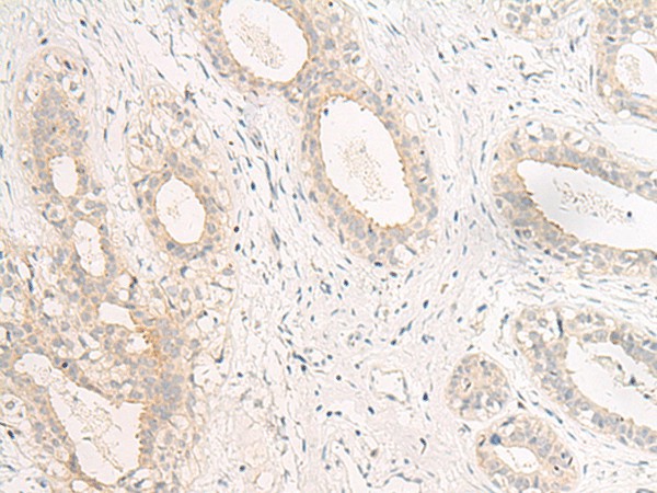 Immunohistochemistry of paraffin-embedded Human breast cancer tissue  using GPR157 Polyclonal Antibody at dilution of 1:60(?200)