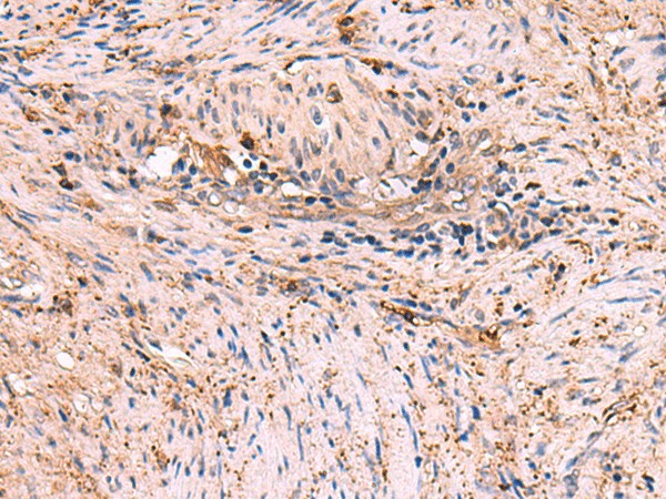 Immunohistochemistry of paraffin-embedded Human cervical cancer tissue  using MAPK8IP3 Polyclonal Antibody at dilution of 1:45(?200)