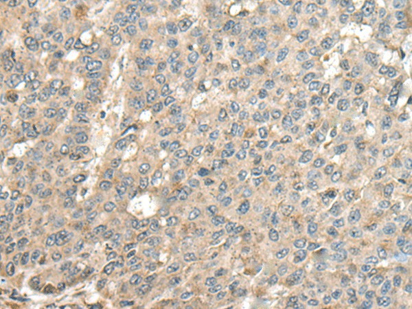 Immunohistochemistry of paraffin-embedded Human liver cancer tissue  using CASQ1 Polyclonal Antibody at dilution of 1:100(?200)