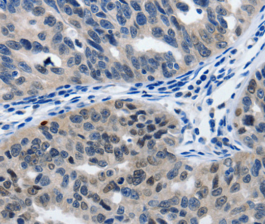 Immunohistochemistry of paraffin-embedded Human ovarian cancer tissue using MATN1 Polyclonal Antibody at dilution 1:60