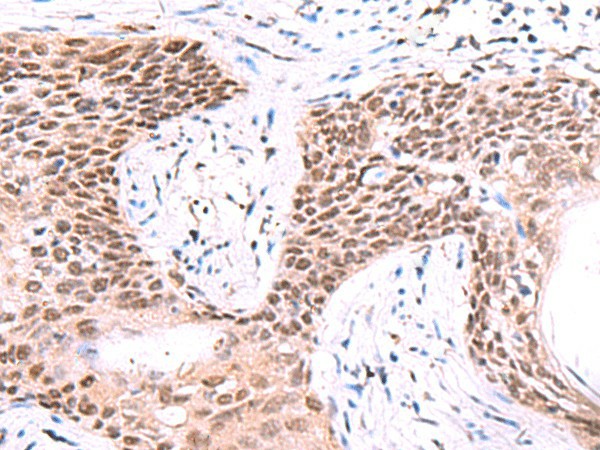 Immunohistochemistry of paraffin-embedded Human esophagus cancer tissue  using IRF2BP1 Polyclonal Antibody at dilution of 1:40(?200)