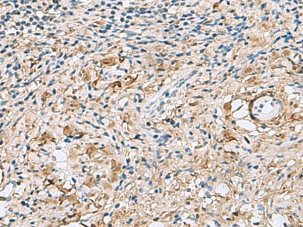 Immunohistochemistry of paraffin-embedded Human cervical cancer tissue  using TMEM141 Polyclonal Antibody at dilution of 1:60(?200)