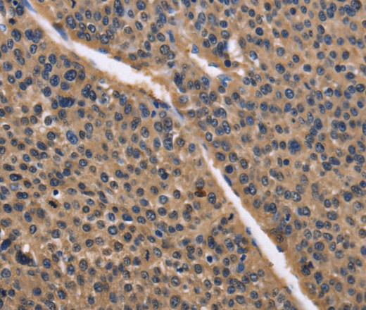 Immunohistochemistry of paraffin-embedded Human liver cancer using IDH1 Polyclonal Antibody at dilution of 1:50