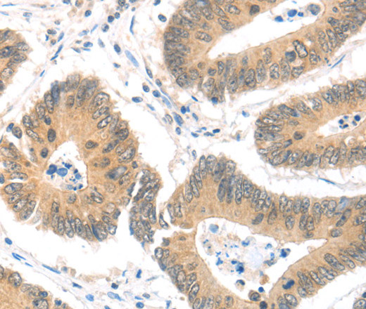 Immunohistochemistry of paraffin-embedded Human colon cancer using MAGED1 Polyclonal Antibody at dilution of 1:30