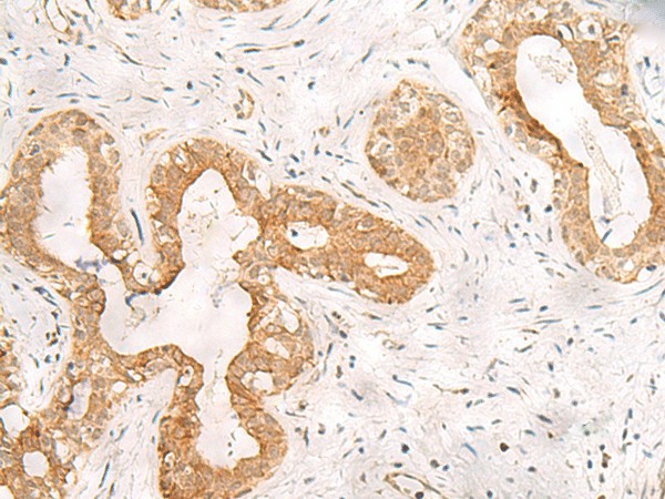 Immunohistochemistry of paraffin-embedded Human breast cancer tissue  using ORC4 Polyclonal Antibody at dilution of 1:80(?200)