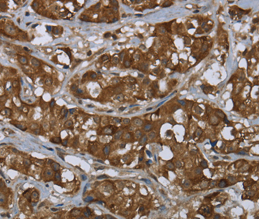 Immunohistochemistry of paraffin-embedded Human breast cancer tissue using PIP Polyclonal Antibody at dilution 1:50