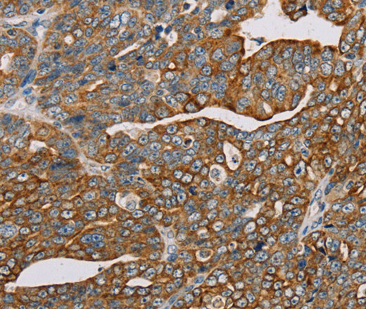 Immunohistochemistry of paraffin-embedded Human cervical cancer using MTFP1 Polyclonal Antibody at dilution of 1:30