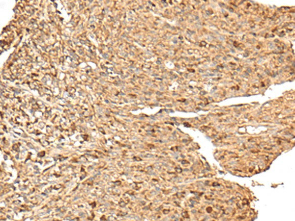 Immunohistochemistry of paraffin-embedded Human liver cancer tissue  using RPS12 Polyclonal Antibody at dilution of 1:70(?200)