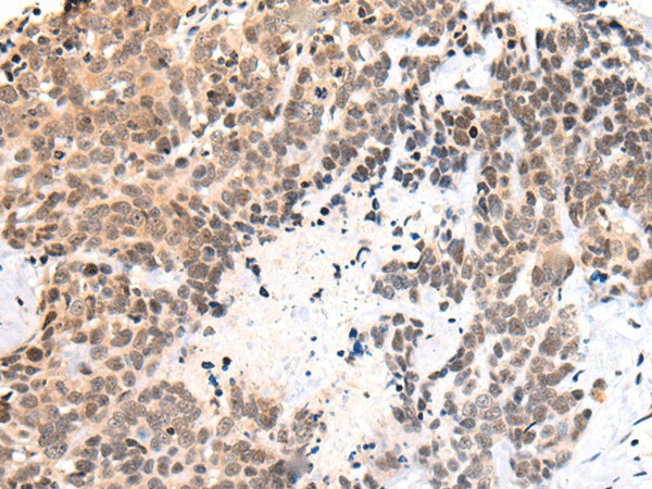 Immunohistochemistry of paraffin-embedded Human thyroid cancer tissue  using C14orf169 Polyclonal Antibody at dilution of 1:45(?200)