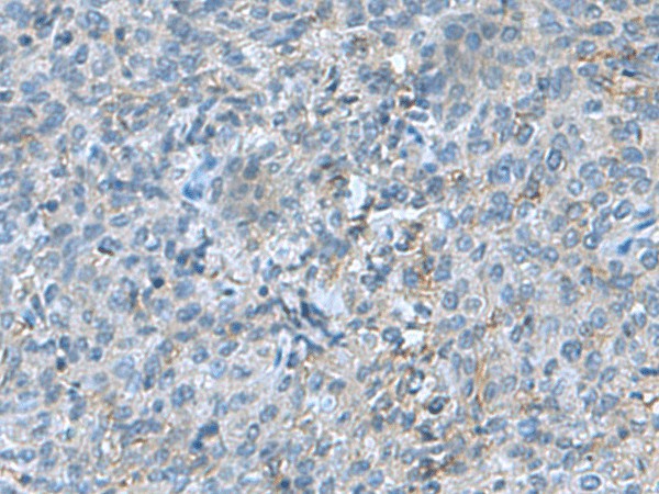 Immunohistochemistry of paraffin-embedded Human cervical cancer tissue  using SRPK2 Polyclonal Antibody at dilution of 1:55(?200)