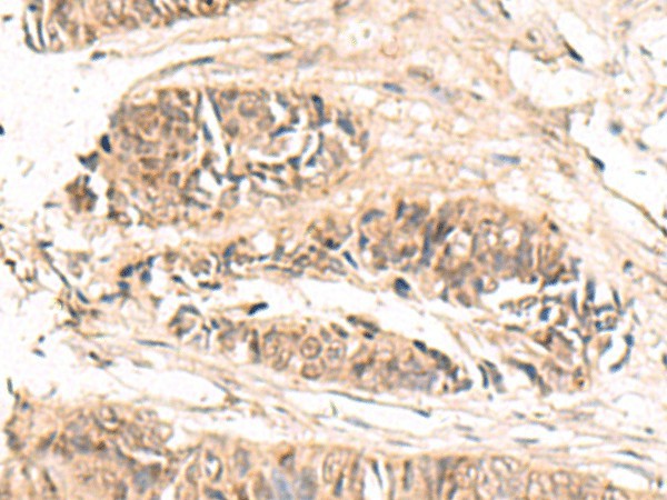 Immunohistochemistry of paraffin-embedded Human colorectal cancer tissue  using ABCB4 Polyclonal Antibody at dilution of 1:70(?200)