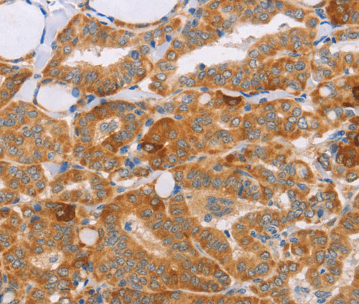 Immunohistochemistry of paraffin-embedded Human thyroid cancer tissue using CARD6 Polyclonal Antibody at dilution 1:60