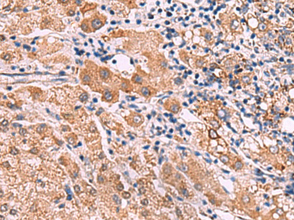 Immunohistochemistry of paraffin-embedded Human liver cancer tissue  using IPPK Polyclonal Antibody at dilution of 1:30(?200)