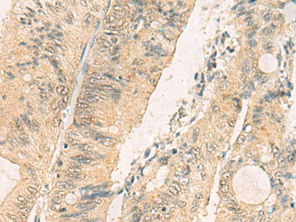 Immunohistochemistry of paraffin-embedded Human colorectal cancer tissue  using THG1L Polyclonal Antibody at dilution of 1:70(?200)