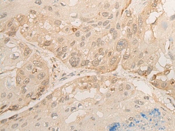 Immunohistochemistry of paraffin-embedded Human esophagus cancer tissue  using DROSHA Polyclonal Antibody at dilution of 1:45(?200)