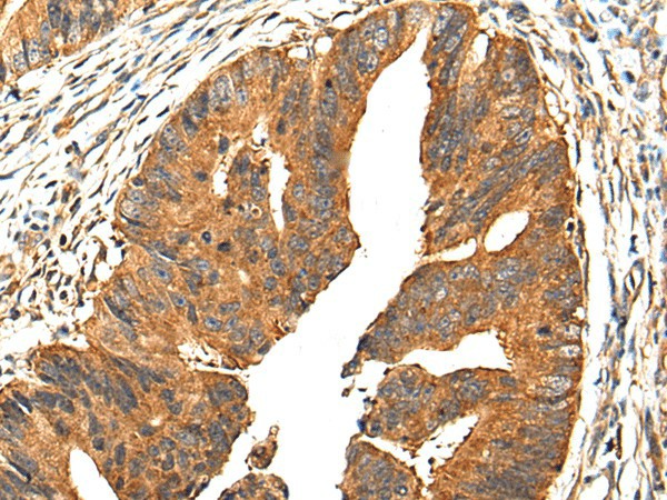 Immunohistochemistry of paraffin-embedded Human colorectal cancer tissue  using PIBF1 Polyclonal Antibody at dilution of 1:30(?200)