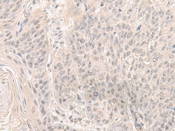 Immunohistochemistry of paraffin-embedded Human esophagus cancer tissue  using HENMT1 Polyclonal Antibody at dilution of 1:30(?200)