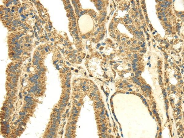 Immunohistochemistry of paraffin-embedded Human thyroid cancer using SDHA Polyclonal Antibody at dilution of  1/40