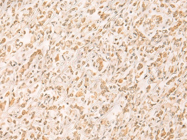 Immunohistochemistry of paraffin-embedded Human gastric cancer tissue  using SETD1A Polyclonal Antibody at dilution of 1:25(?200)