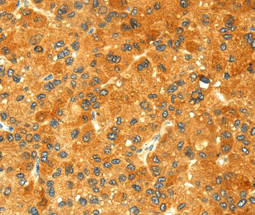 Immunohistochemistry of paraffin-embedded Human liver cancer tissue using GK1 Polyclonal Antibody at dilution 1:60