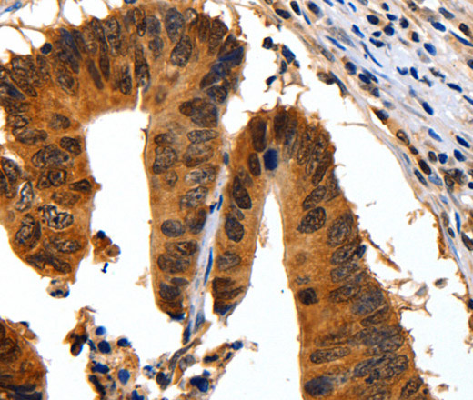 Immunohistochemistry of paraffin-embedded Human colon cancer using 14-3-3 beta/alpha Polyclonal Antibody at dilution of 1:30