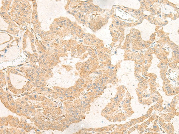 Immunohistochemistry of paraffin-embedded Human thyroid cancer tissue  using GNAT3 Polyclonal Antibody at dilution of 1:40(?200)