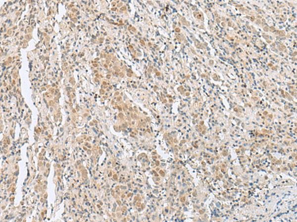 Immunohistochemistry of paraffin-embedded Human cervical cancer tissue  using HIST1H2BK Polyclonal Antibody at dilution of 1:60(?200)